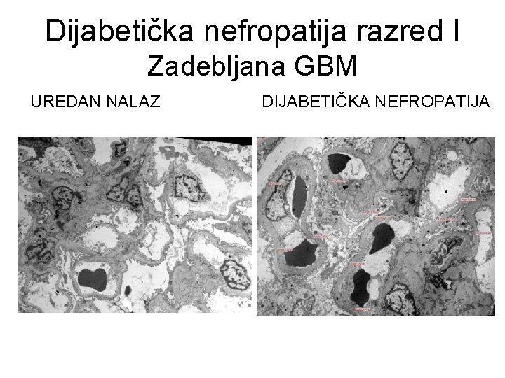 Dijabetička nefropatija razred I Zadebljana GBM UREDAN NALAZ DIJABETIČKA NEFROPATIJA 