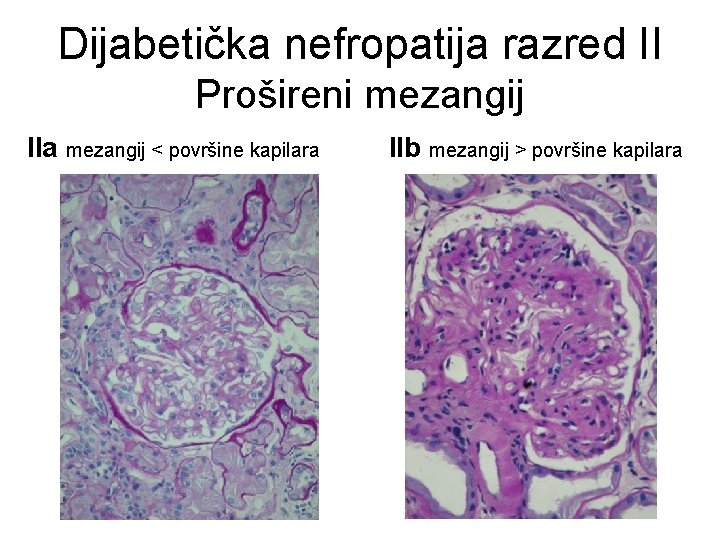 Dijabetička nefropatija razred II Prošireni mezangij IIa mezangij < površine kapilara IIb mezangij >