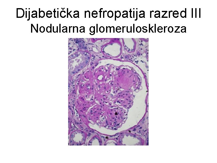 Dijabetička nefropatija razred III Nodularna glomeruloskleroza 