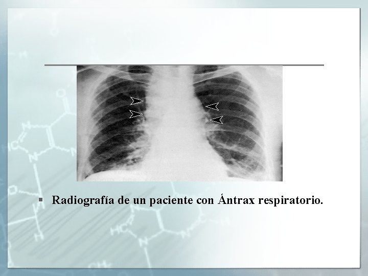 § Radiografía de un paciente con Ántrax respiratorio. 