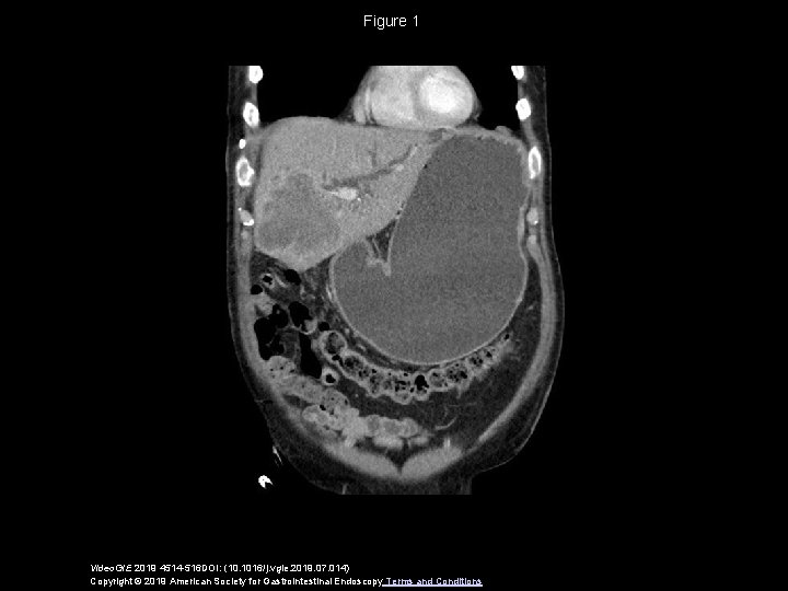 Figure 1 Video. GIE 2019 4514 -516 DOI: (10. 1016/j. vgie. 2019. 07. 014)