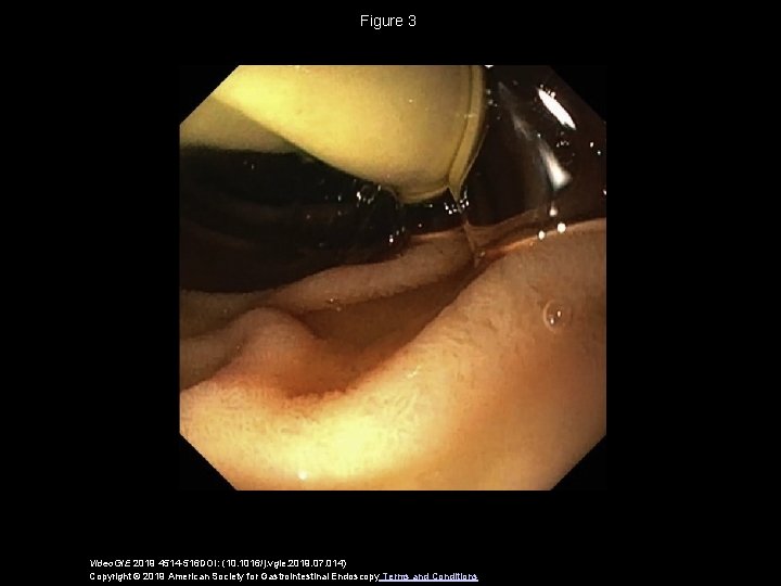 Figure 3 Video. GIE 2019 4514 -516 DOI: (10. 1016/j. vgie. 2019. 07. 014)