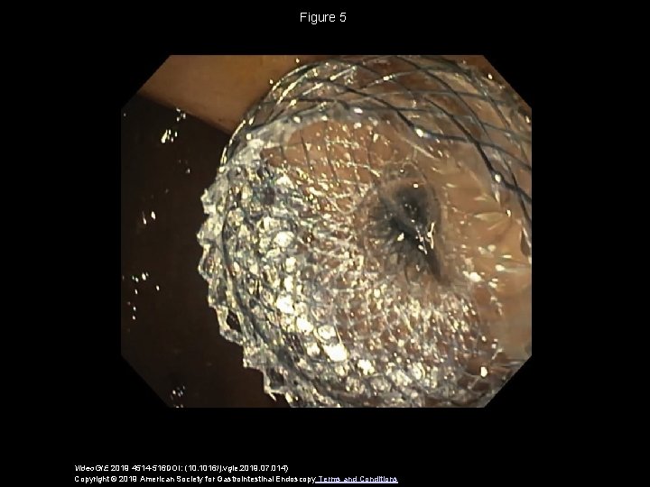Figure 5 Video. GIE 2019 4514 -516 DOI: (10. 1016/j. vgie. 2019. 07. 014)