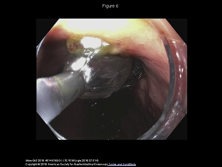 Figure 6 Video. GIE 2019 4514 -516 DOI: (10. 1016/j. vgie. 2019. 07. 014)