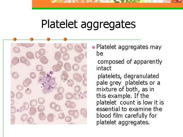 Platelet aggregates n Platelet aggregates may be composed of apparently intact platelets, degranulated pale