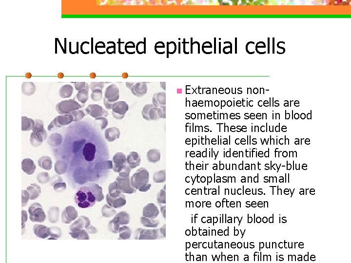 Nucleated epithelial cells n Extraneous nonhaemopoietic cells are sometimes seen in blood films. These