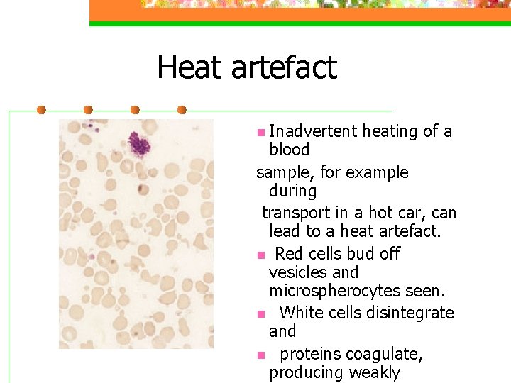 Heat artefact n Inadvertent heating of a blood sample, for example during transport in
