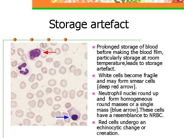Storage artefact n n Prolonged storage of blood before making the blood film, particularly