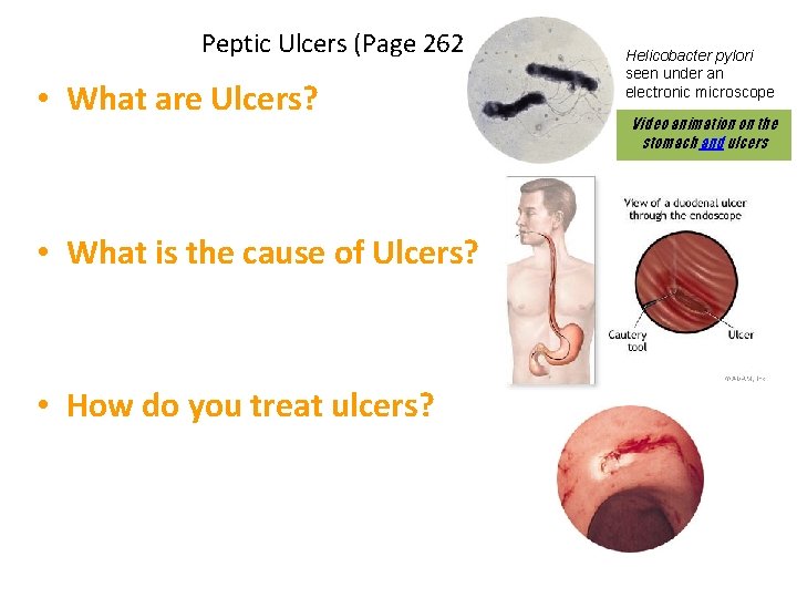 Peptic Ulcers (Page 262): • What are Ulcers? Helicobacter pylori seen under an electronic