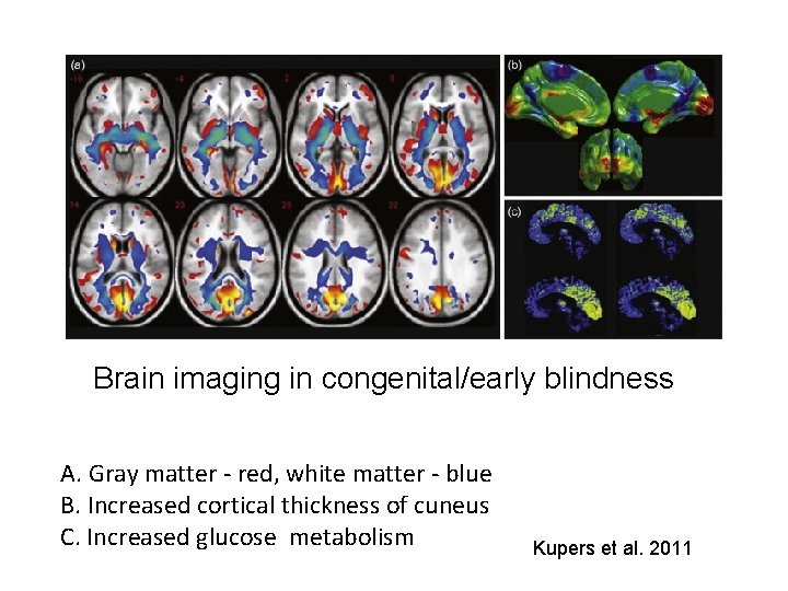 Brain imaging in congenital/early blindness A. Gray matter - red, white matter - blue