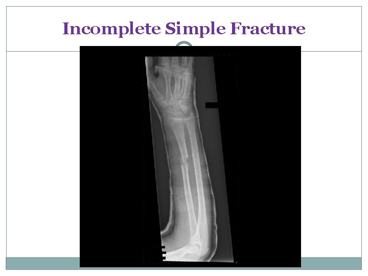 Incomplete Simple Fracture 