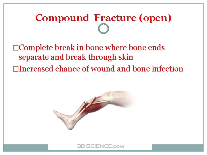 Compound Fracture (open) �Complete break in bone where bone ends separate and break through