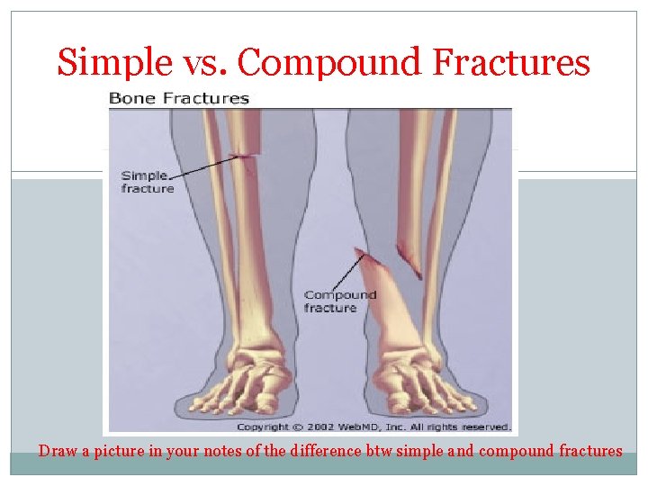 Simple vs. Compound Fractures Draw a picture in your notes of the difference btw