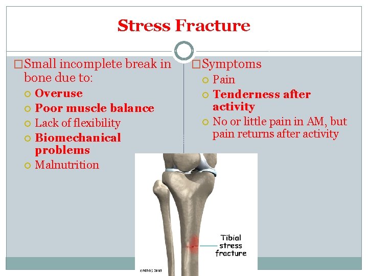 Stress Fracture �Small incomplete break in bone due to: Overuse Poor muscle balance Lack