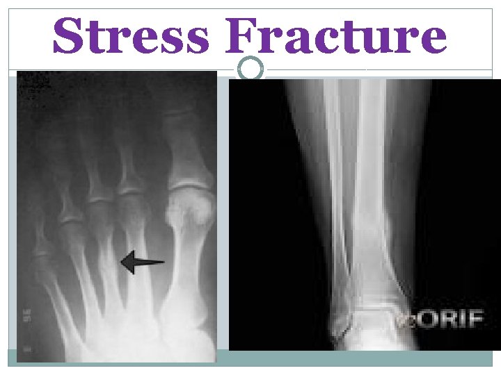 Stress Fracture 