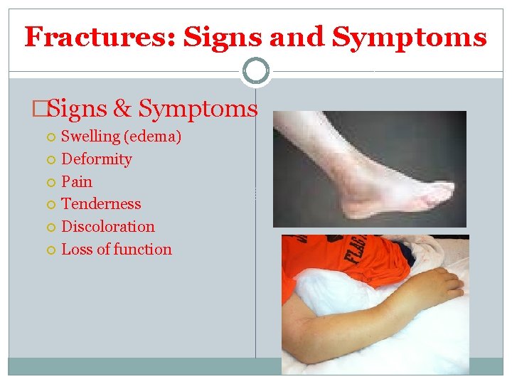 Fractures: Signs and Symptoms �Signs & Symptoms Swelling (edema) Deformity Pain Tenderness Discoloration Loss