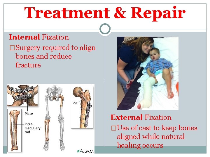 Treatment & Repair Internal Fixation �Surgery required to align bones and reduce fracture External