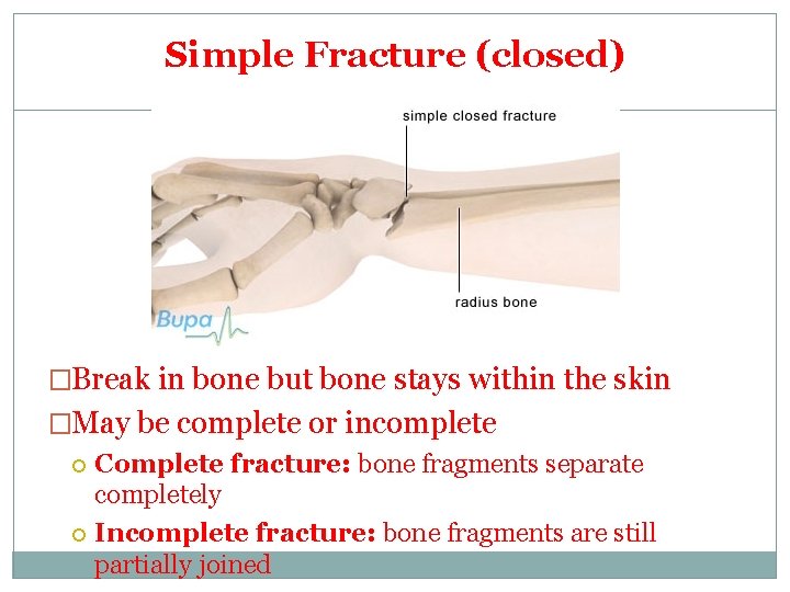 Simple Fracture (closed) �Break in bone but bone stays within the skin �May be