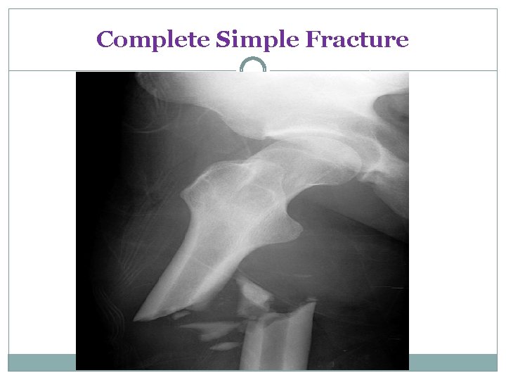 Complete Simple Fracture 