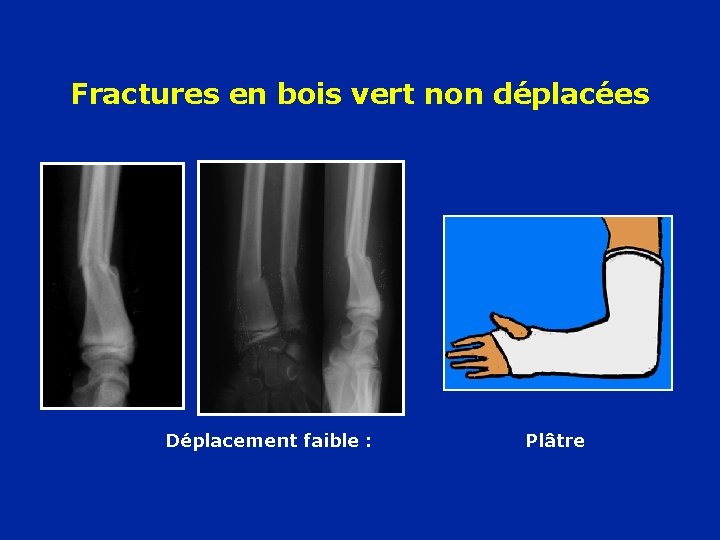 Fractures en bois vert non déplacées Déplacement faible : Plâtre 