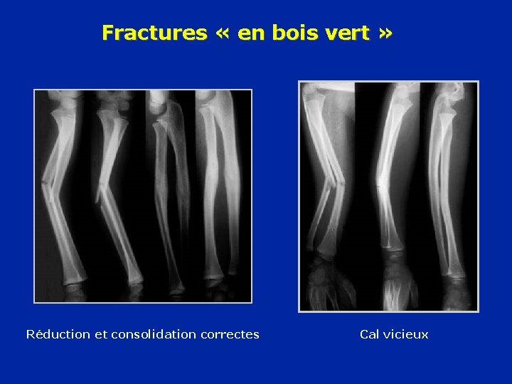 Fractures « en bois vert » Réduction et consolidation correctes Cal vicieux 