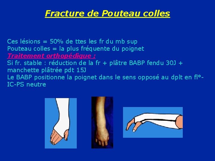 Fracture de Pouteau colles Ces lésions = 50% de ttes les fr du mb