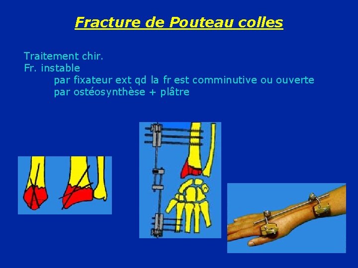 Fracture de Pouteau colles Traitement chir. Fr. instable par fixateur ext qd la fr