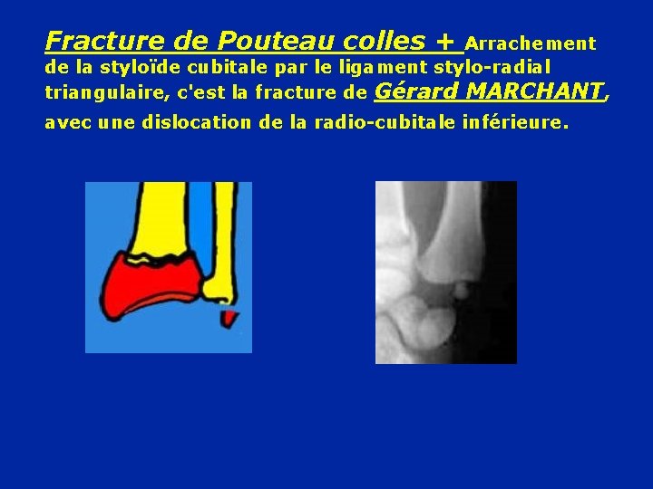 Fracture de Pouteau colles + Arrachement de la styloïde cubitale par le ligament stylo-radial