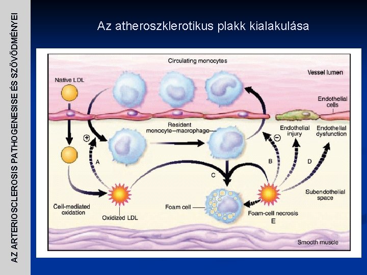 AZ ARTERIOSCLEROSIS PATHOGENESISE ÉS SZÖVŐDMÉNYEI Az atheroszklerotikus plakk kialakulása 