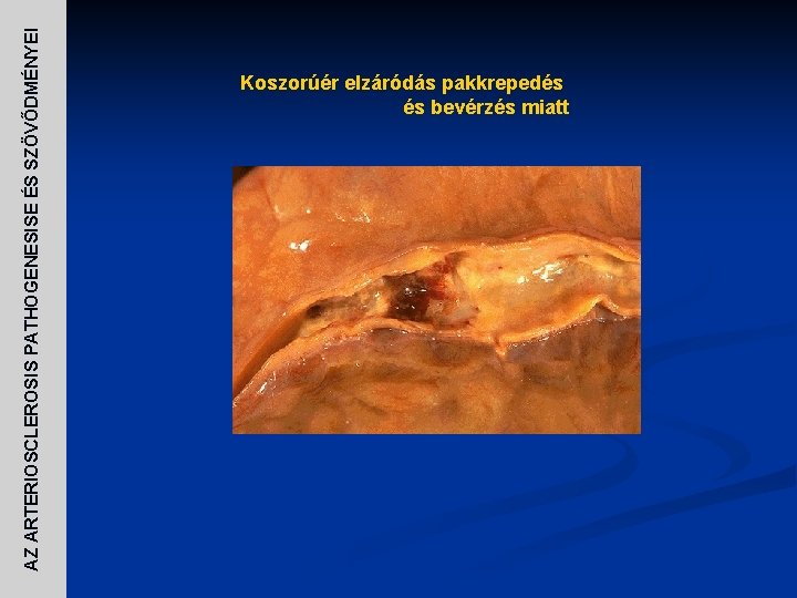 AZ ARTERIOSCLEROSIS PATHOGENESISE ÉS SZÖVŐDMÉNYEI Koszorúér elzáródás pakkrepedés és bevérzés miatt 