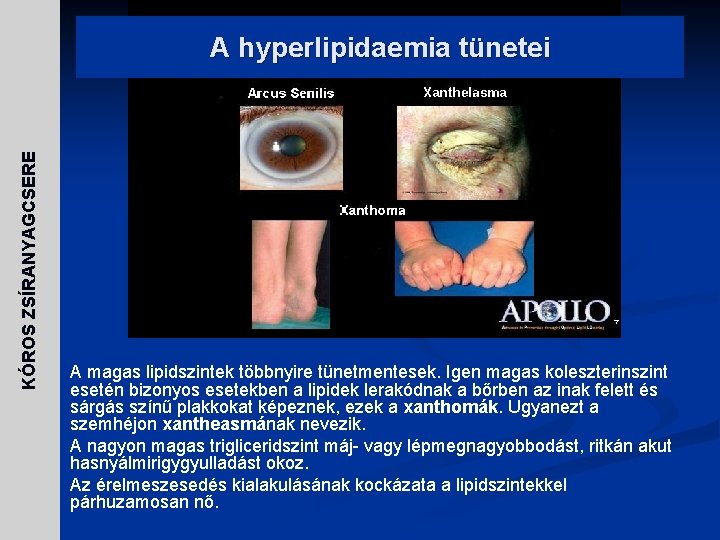 KÓROS ZSÍRANYAGCSERE A hyperlipidaemia tünetei n n n A magas lipidszintek többnyire tünetmentesek. Igen