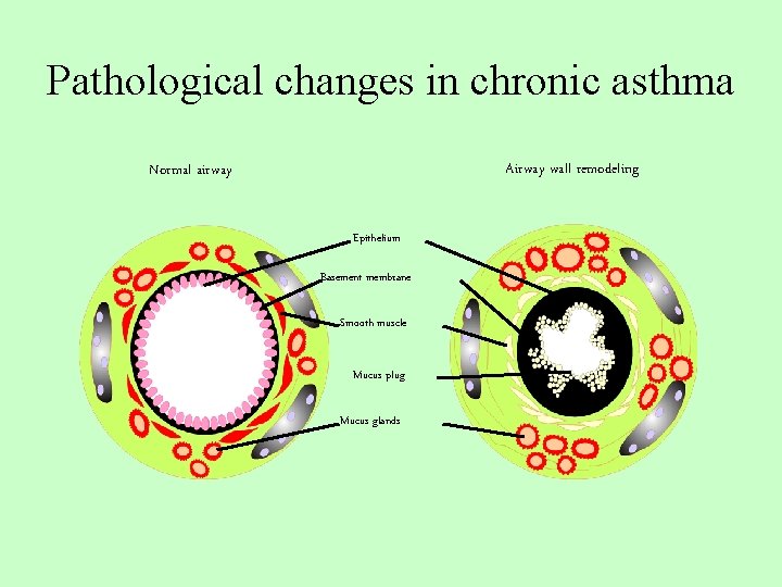 Pathological changes in chronic asthma Airway wall remodeling Normal airway Epithelium Basement membrane Smooth