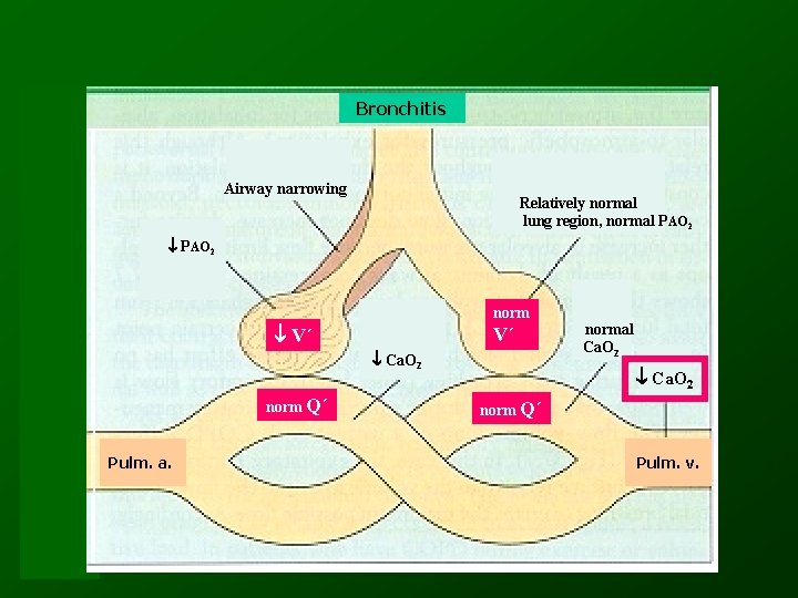 Bronchitis Airway narrowing Relatively normal lung region, normal PAO 2 norm V´ V´ Ca.