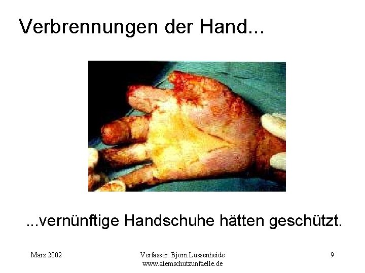 Verbrennungen der Hand. . . vernünftige Handschuhe hätten geschützt. März 2002 Verfasser: Björn Lüssenheide