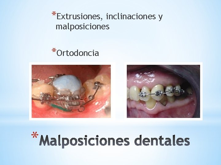 *Extrusiones, inclinaciones y malposiciones *Ortodoncia * 
