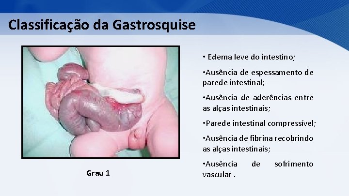 Classificação da Gastrosquise • Edema leve do intestino; • Ausência de espessamento de parede