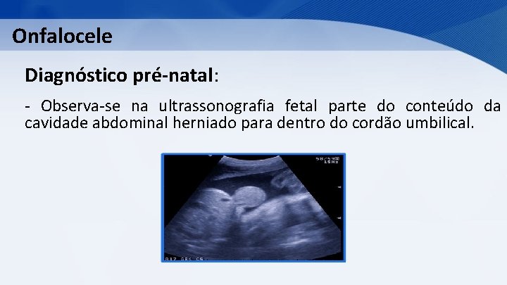 Onfalocele Diagnóstico pré-natal: - Observa-se na ultrassonografia fetal parte do conteúdo da cavidade abdominal