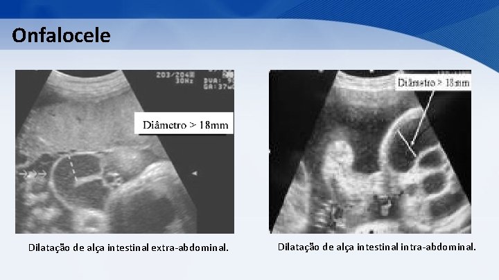 Onfalocele Dilatação de alça intestinal extra-abdominal. Dilatação de alça intestinal intra-abdominal. 