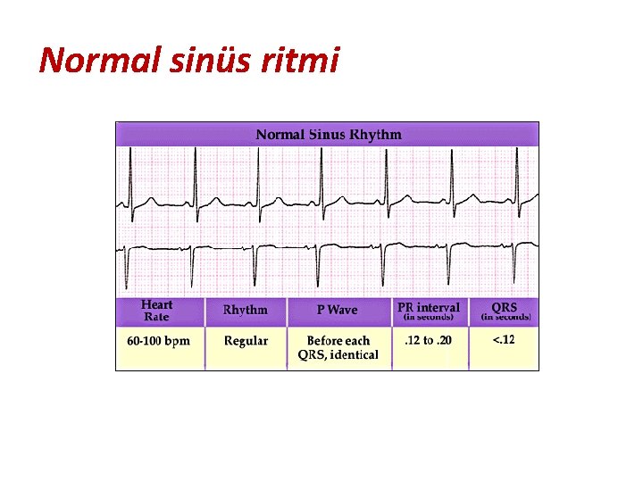 Normal sinüs ritmi 