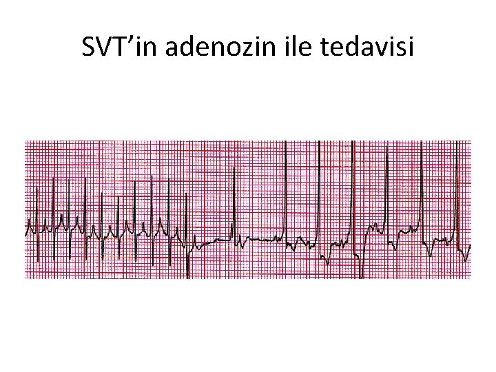 SVT’in adenozin ile tedavisi 