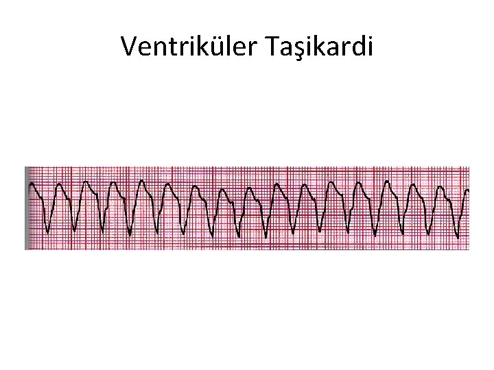 Ventriküler Taşikardi 