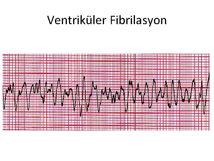 Ventriküler Fibrilasyon 