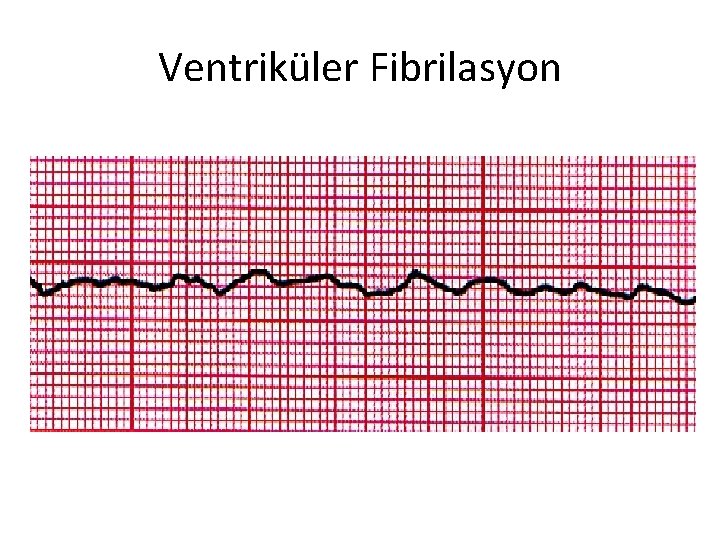 Ventriküler Fibrilasyon 