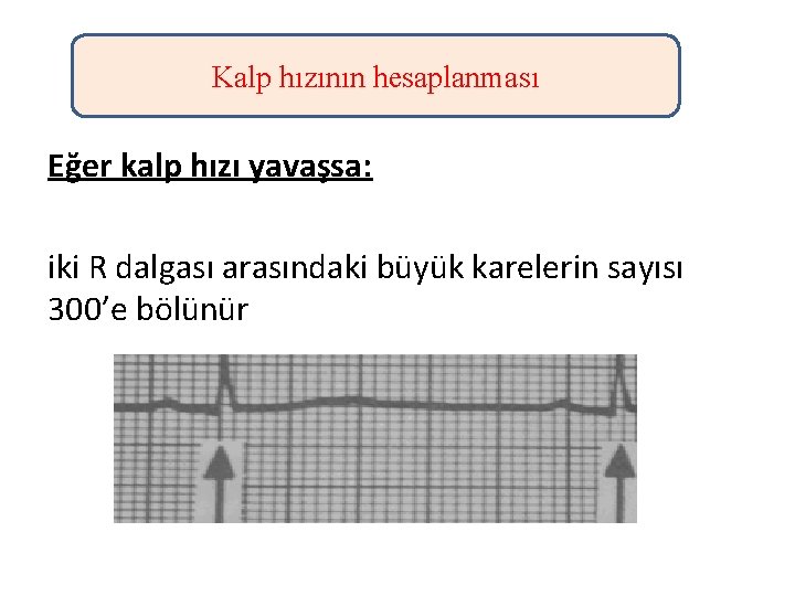 Kalp hızının hesaplanması Eğer kalp hızı yavaşsa: iki R dalgası arasındaki büyük karelerin sayısı