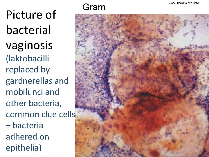 Picture of bacterial vaginosis (laktobacilli replaced by gardnerellas and mobilunci and other bacteria, common