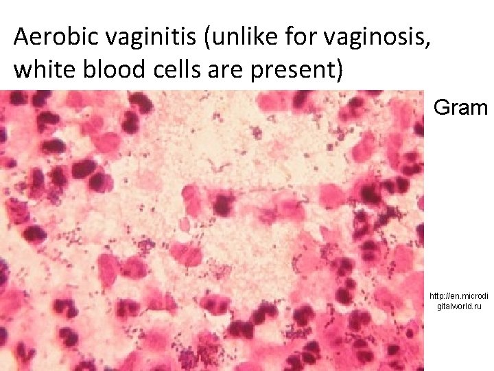 Aerobic vaginitis (unlike for vaginosis, white blood cells are present) Gram http: //en. microdi