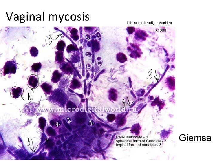 Vaginal mycosis http: //en. microdigitalworld. ru Giemsa 