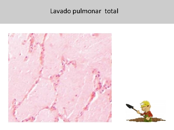 Lavado pulmonar total 