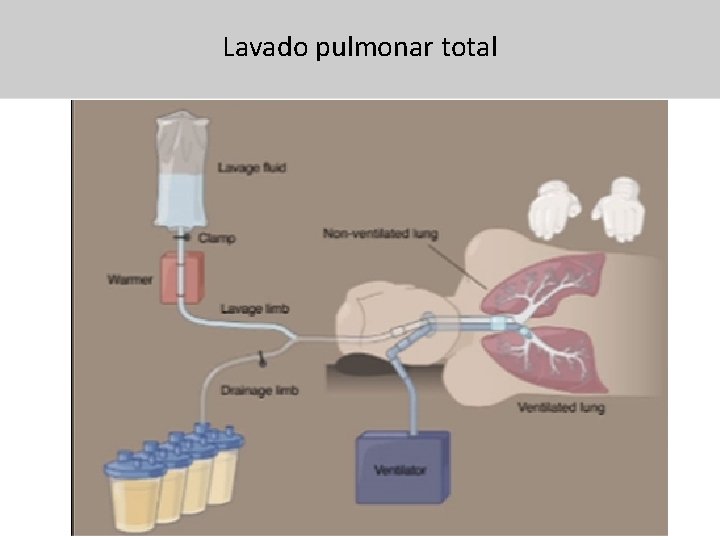 Lavado pulmonar total 