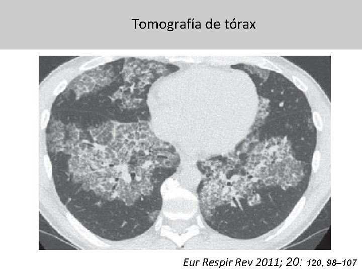 Tomografía de tórax 31/07/13 Eur Respir Rev 2011; 20: 120, 98– 107 